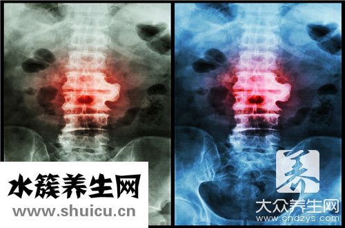 脊柱炎治療