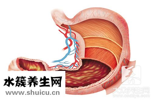胃大部切除術