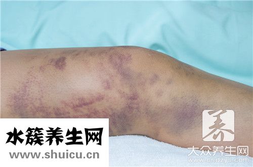 軟組織挫傷用什么藥
