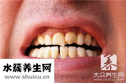 牙齒結石自己弄掉