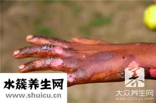 傷口會癢