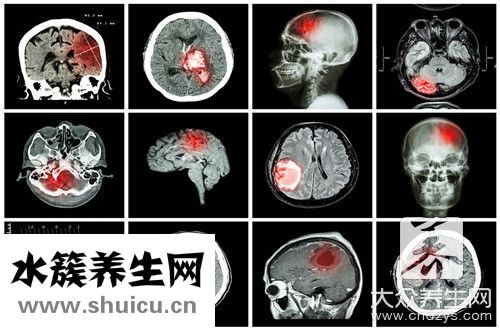 血管支架手術