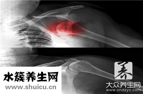 肋骨骨折癥狀