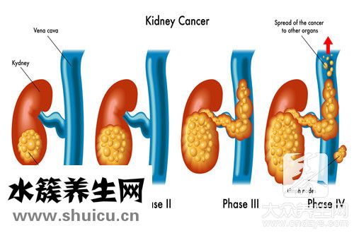 慢性腎臟病3期