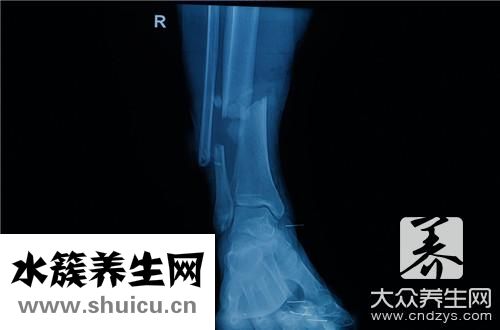 脛骨痛