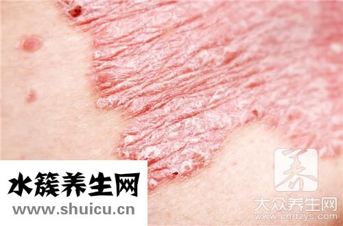 癬治療