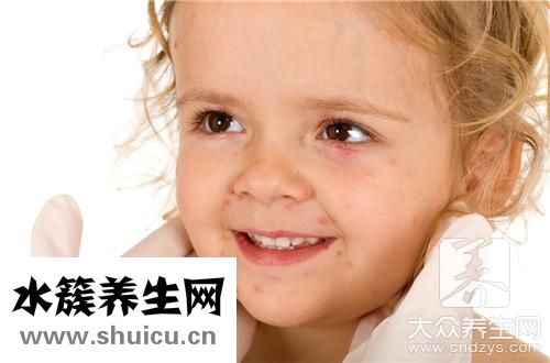 蚊子咬包