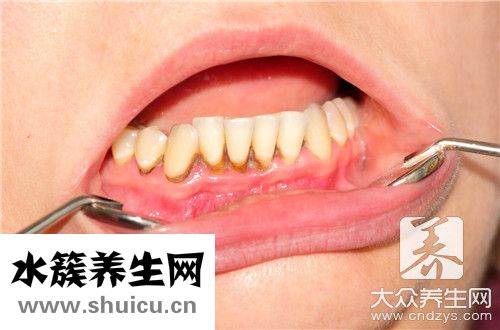 牙齦出血不止