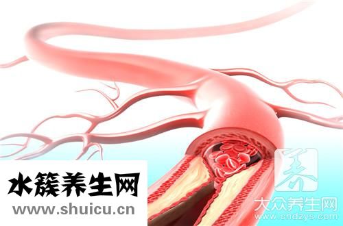 血管斑塊能消除嗎