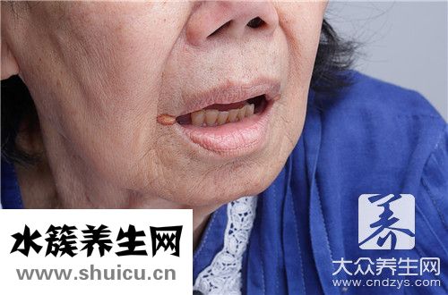 嘴唇炎