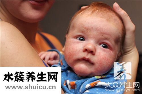 長濕疹是身體排毒表現