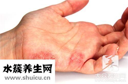 治尋麻疹