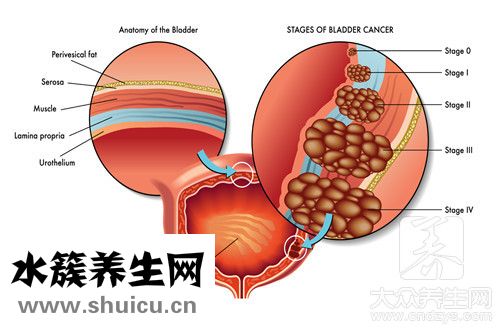 導管內癌