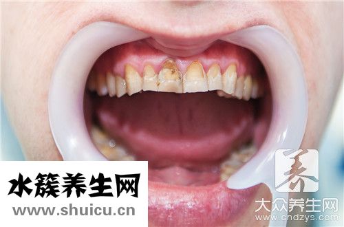 牙齒有黑垢辦