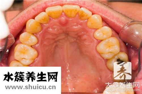 牙上有黑線