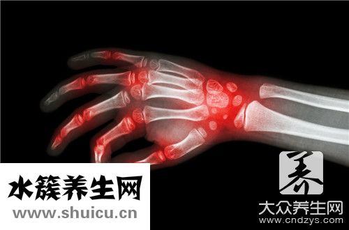痛風腳腫消腫