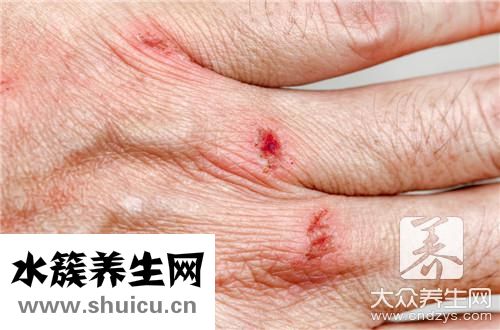 疤痕修復膏
