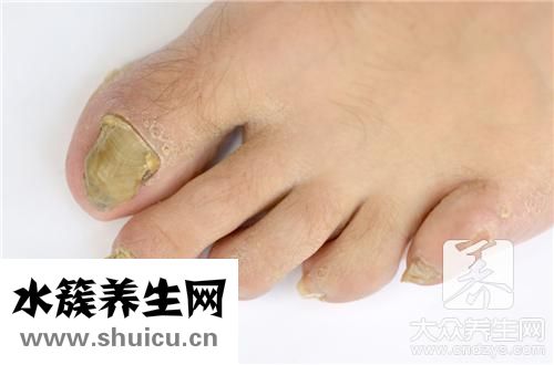腳趾甲里面有黑塊