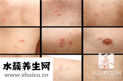 皮樣囊腫