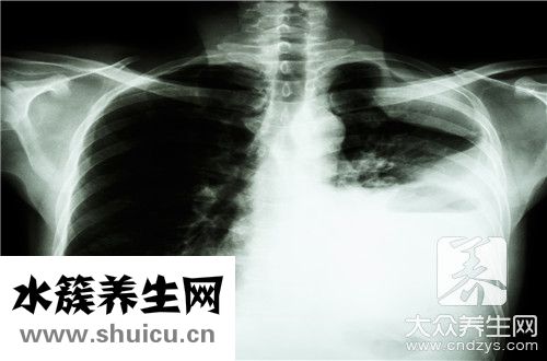 肺結核治療