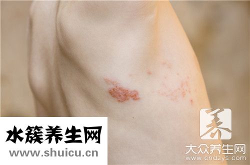 皰疹是啥病