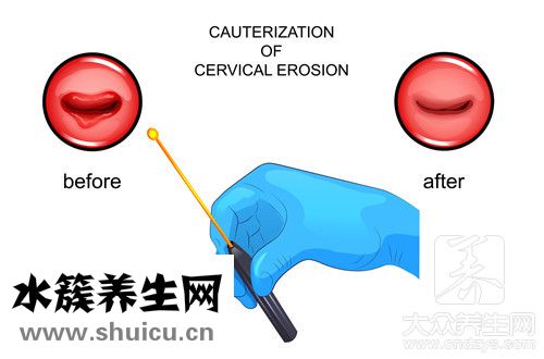 囊性包塊