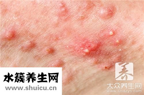 膿包痘痘不擠會自然消