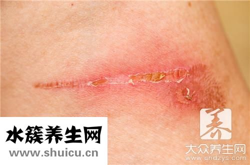 去除疤痕簡單方法