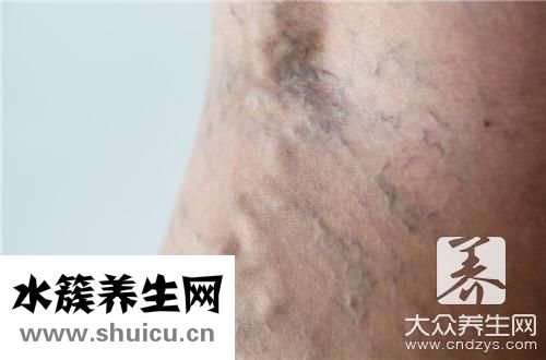 靜脈血管曲張