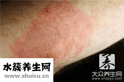 紫癜會癢嗎