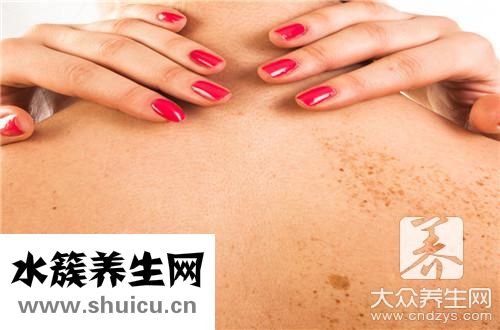 痣和斑區別