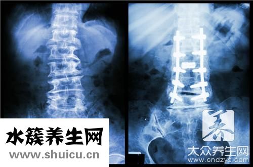 脊椎疼痛辦