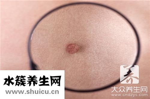 擠痘痘留下疤痕