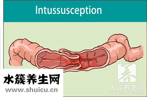 造口并發癥