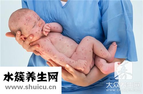 屁股溝濕疹
