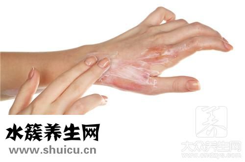 卷發棒燙傷