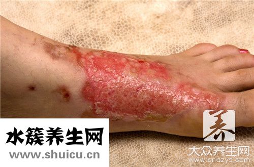 燙傷修復