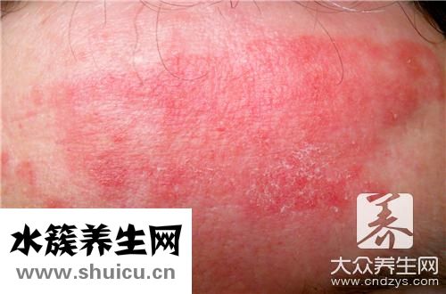 濕疹脫皮
