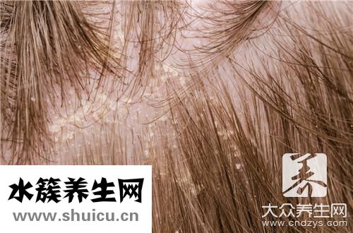 頭皮問題