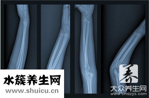 髖臼骨折