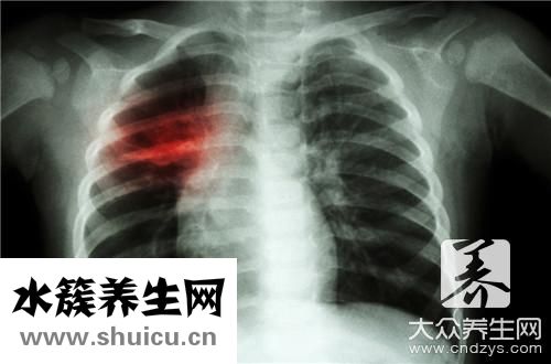 開放性肺結核