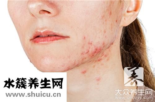 下巴左邊長痘