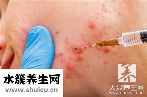 下巴左邊長痘