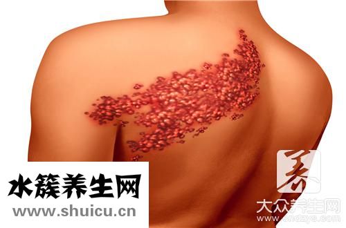 帶狀泡癥水泡幾天能消