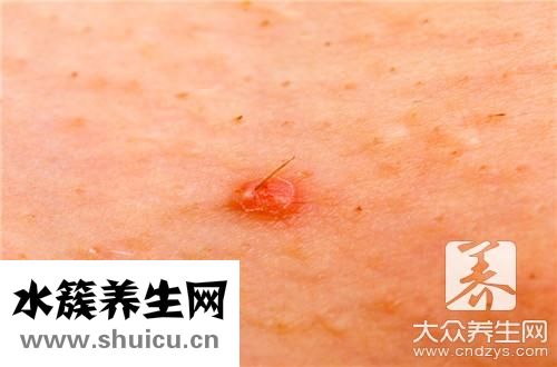 毛囊炎涂什么藥膏最好