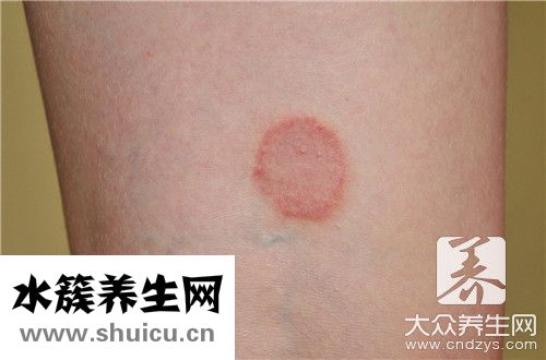 玫瑰濕疹