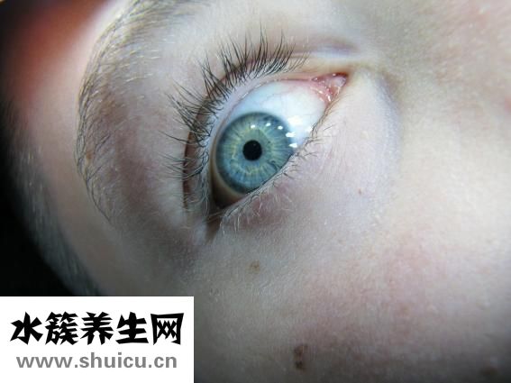 怎么虹膜變異