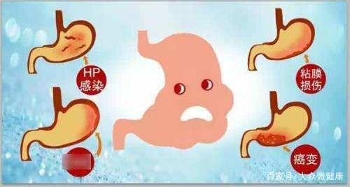 幽門螺桿菌的癥狀表現，女性感染幽門螺桿菌的癥狀表現