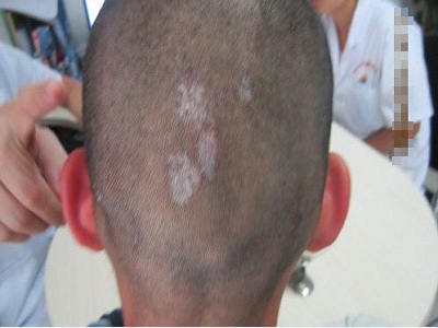 男性得了性疾病早期圖片，男性得了性疾病早期圖片渝都醫院有活動嗎