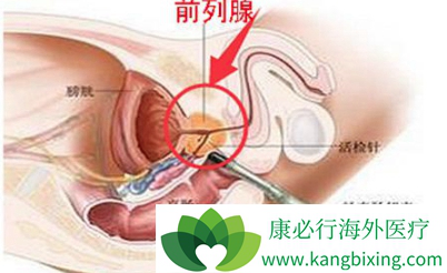 前列腺癌的早期癥狀，前列腺癌的早期癥狀有哪些圖片